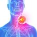 Innovative Theranostic Strategy Advances Detection and Treatment of Neuroendocrine Prostate Cancer — Cancer