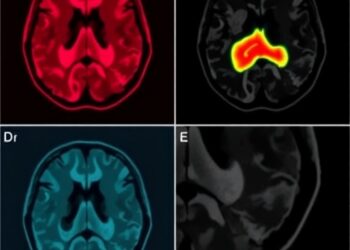 Intraventricular Hemorrhage Rates and Predictors Compared — Medicine