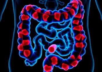 Leukocyte Levels Linked to Colorectal Cancer Survival — Cancer