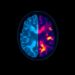 MRI Endpoints Redefined for Ataxia Clinical Trials — Medicine