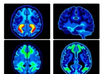 PET Imaging Uncovers Synaptic Loss in Multiple Sclerosis: Insights from Preclinical and Human Studies — Medicine