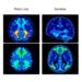 PET Imaging Uncovers Synaptic Loss in Multiple Sclerosis: Insights from Preclinical and Human Studies — Medicine