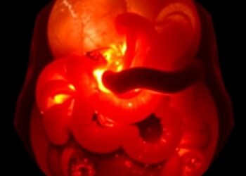 Rare Intestinal Tumor Mimicking Intussusception Sheds Light on Diagnostic Challenges in Young Women — Cancer