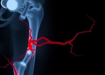 Rare Superficial Femoral Artery Thrombosis Post-PFNA — Medicine