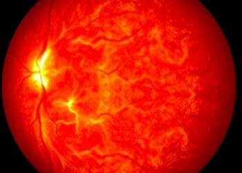 Retinal Imaging Reveals Key Predictors of Alzheimer’s Disease Risk — Technology and Engineering