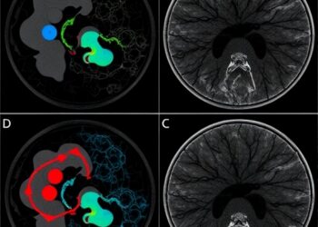 Tracing Metastasis and Evolution in Uveal Melanoma — Cancer