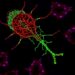 Tumor-Promoting Role of MSX1 in Cervical Cancer — Medicine