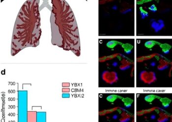 YBX1 Drives Immune Evasion in Lung Cancer Bone Metastases — Medicine