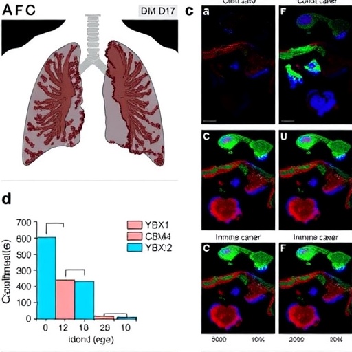 YBX1 Drives Immune Evasion in Lung Cancer Bone Metastases — Medicine