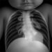 Alveolar Capillary Dysplasia in Neonates: Multicenter Study — Technology and Engineering