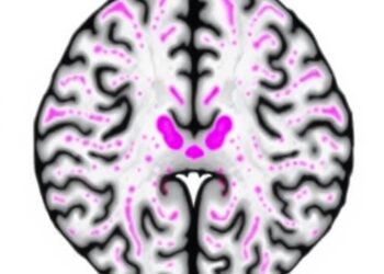Lewy Pathology Rare in Prefrontal Cortex of Parkinson’s — Medicine