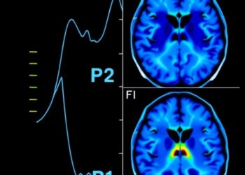 Neuroimaging Reveals Nigrostriatal Decline Gradient in Parkinson’s — Medicine