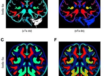 Personalized Neoantigen Dendritic Cell Vaccine in Glioblastoma — Medicine