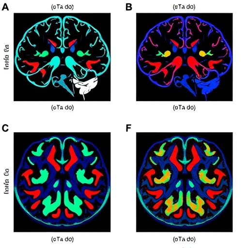 Personalized Neoantigen Dendritic Cell Vaccine in Glioblastoma — Medicine