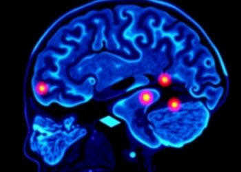 Amyloid PET Quantification Enhances Alzheimer’s Disease Diagnosis Accuracy