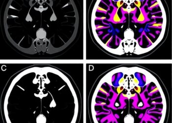 Atezolizumab After Single or Multiple Fractions of Stereotactic Radiotherapy in TNBC