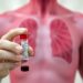Blood Test for Tuberculosis Could Cut Spread of Global Infectious Killer