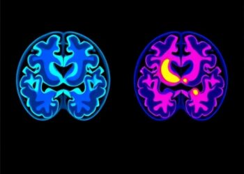 Brain- and Body-First Subtypes Identified in Lewy Body Disease