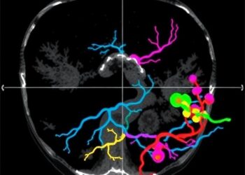 Deep Learning and Ultrasound Predict Microvascular Invasion in Liver Cancer