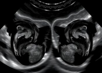Delayed vs Early Cord Clamping in Preterm Twins: Echocardiography Study