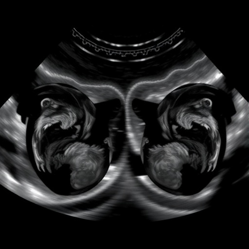 Delayed vs Early Cord Clamping in Preterm Twins: Echocardiography Study