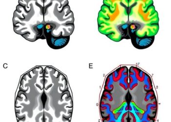 Distinct Spatiotemporal Patterns in Brain Networks Linked to PTSD