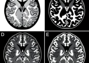 Early Brain Morphology and Cortical Microstructure Deviations in Schizophrenia Spectrum