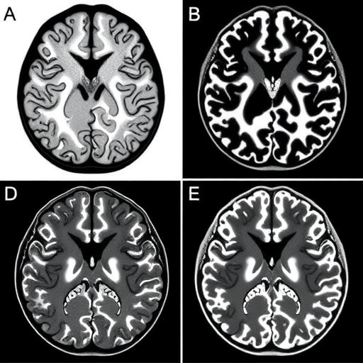 Early Brain Morphology and Cortical Microstructure Deviations in Schizophrenia Spectrum