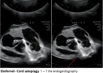Echocardiography Markers After Deferred Cord Clamping With Varying Oxygen Levels