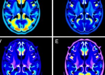 fMRI reveals target-specific brain networks during active GPi deep brain stimulation