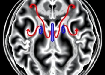 Link Between Carotid Hemodynamics and Cerebral Blood Flow in Early Simulated Microgravity