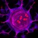 Lipids in Ovarian Cancer Ascites Impair T Cell Activation by Disturbing TCR Dynamics