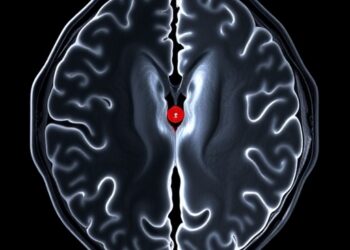 Millisecond magnetic particle imaging of a cerebral aneurysm phantom with and without flow diverter stent