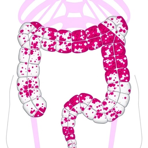 Novel Prognostic Biomarker and Oncogenic Driver Identified in Colorectal Cancer