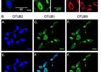 OTUB1 Suppresses Autophagy-Dependent Ferroptosis in Liver Cancer by Stabilizing p62