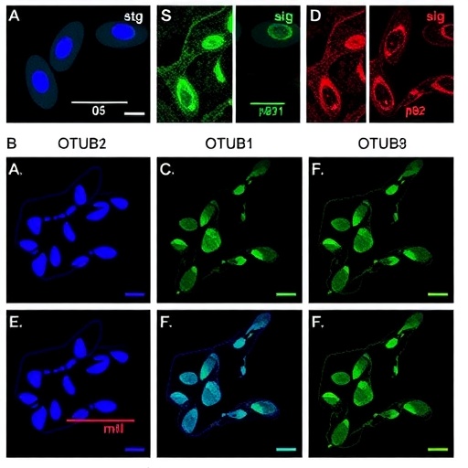 OTUB1 Suppresses Autophagy-Dependent Ferroptosis in Liver Cancer by Stabilizing p62