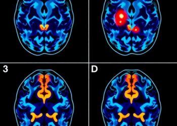 Prefrontal intermittent theta-burst stimulation alters hemodynamic responses in major depression