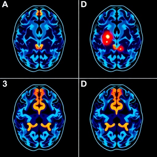 Prefrontal intermittent theta-burst stimulation alters hemodynamic responses in major depression