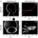Prenatal biometry predicts optimal endotracheal tube depth in very low-birthweight infants