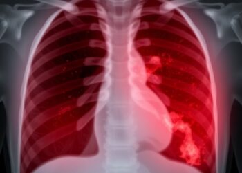 Recurrent Pleural Effusion Case Highlights Diagnostic Challenge Between TB and Other Causes