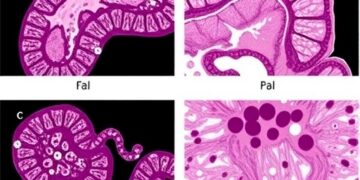 Routine duodenal papillary biopsy enhances detection of duodenal papillary adenoma in familial adenomatous polyposis patients: a prospective cohort study