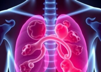 Scientists identify novel hereditary prostate cancer type