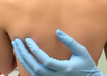 Scientists Quantify Substances Extracted by Cupping Therapy from Skin