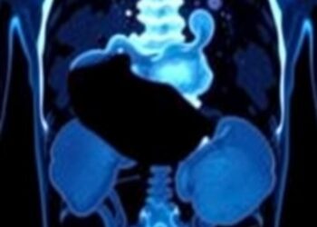Second PSMA PET Scan Alters Treatment in Almost Half of Prostate Cancer Cases
