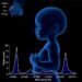 Temporal Changes in Hyaluronan Levels in Preterm Human Breast Milk