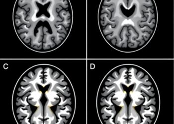 Widespread White Matter Abnormalities Found in First-Episode Schizophrenia Patients