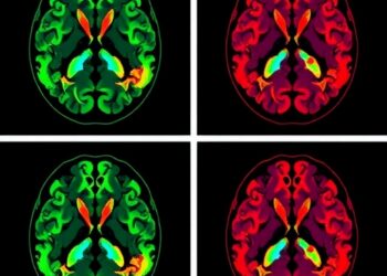 Abnormal cerebrovascular reactivity may signal early psychosis risk in 22q11.2 deletion syndrome
