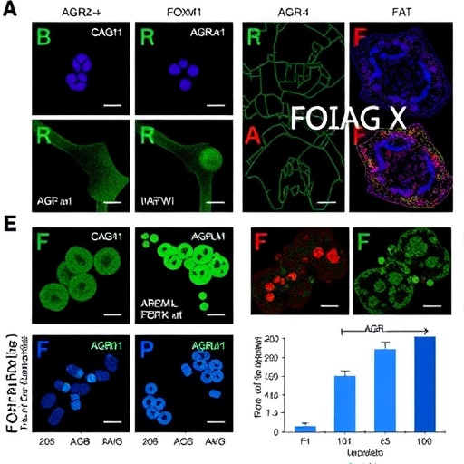 AGR2-high cells fuel FOXM1-driven malignancy and predict outcomes in pancreatic neuroendocrine tumors