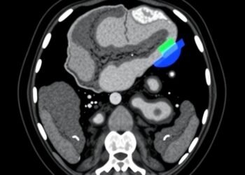 AI Foundation Model Stratifies and Triages Acute Abdominal Diagnoses Using Noncontrast CT