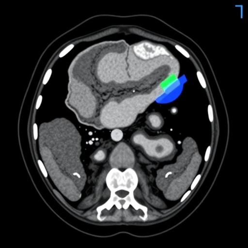 AI Foundation Model Stratifies and Triages Acute Abdominal Diagnoses Using Noncontrast CT